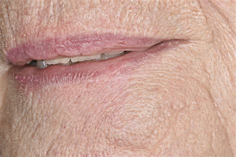 Scar After Squamous Cell Carcinoma Excision Stock Image C0402164