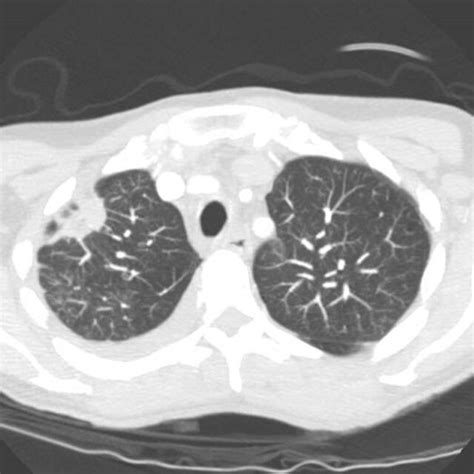 Computed Tomography Scan Showing Right Upper Lobe Speculated Anterior