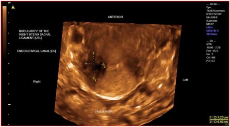 deep infiltrating endometriosis making the diagnosis elliot m levine carlos m fernandez