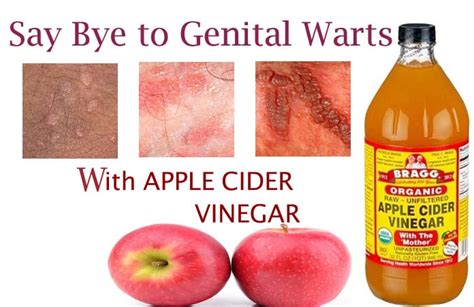 How To Get Rid Of Genital Warts Fast With Apple Cider Vinegar Cure