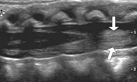 Sonography Of The Neonatal Spine Part 1 Normal Anatomy Imaging