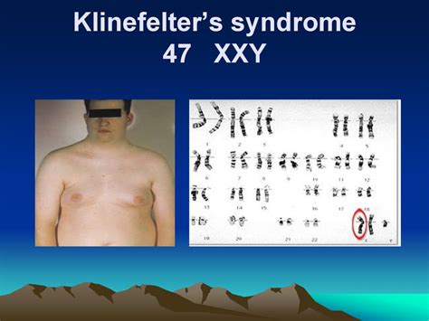 Living With Klinefelter Syndrome Years Later Youtub Vrogue Co