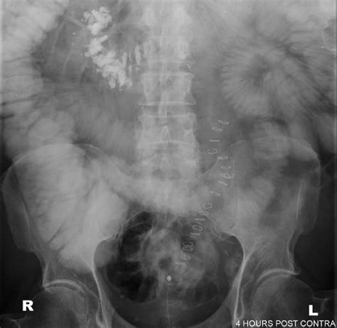 Abdominal X Ray 5 Days Post Laparotomy Download Scientific Diagram