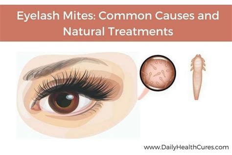 Eyelash Mites Demodex Common Causes Natural Remedies