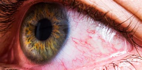 Eye Cancer Symptoms 7 Common Signs Of Eye Cancer