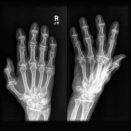 Osteoarthritis Hands X Ray