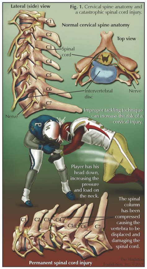 Cervical Spine Injuries In Sports Hughston Clinic