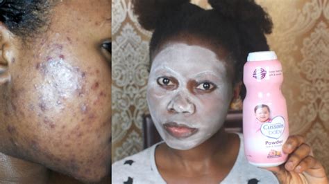 In 3 Days Completely Get Rid Of Acne With Baby Powder Youtube