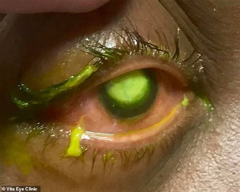 Eye Doctor Shares Shocking Photos After Patient Sleeps With Contact
