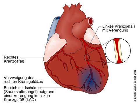 Der herzinfarkt, auch myokardinfarkt genannt, ist. EKG bei Angina pectoris und Herzinfarkt - Deximed