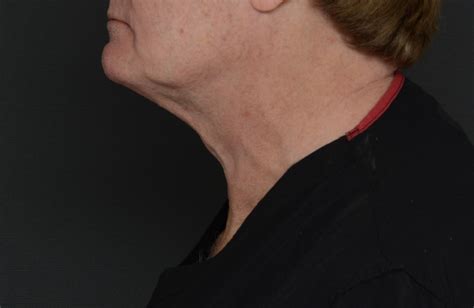 Patient 13934396 Neck Before And After Photos David Amron Md