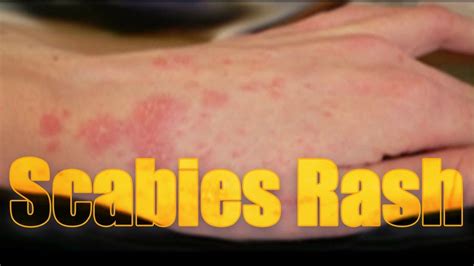 Scabies Rash Itchy Highly Contagious Skin Disease Usapang