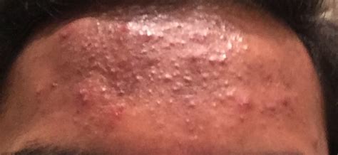 Small Bumps On Forehead Closed Comedones General Acne Discussion