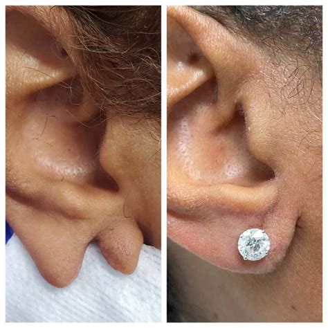 Earlobe Plastic Surgery Before And After Earlobe Repair Before And