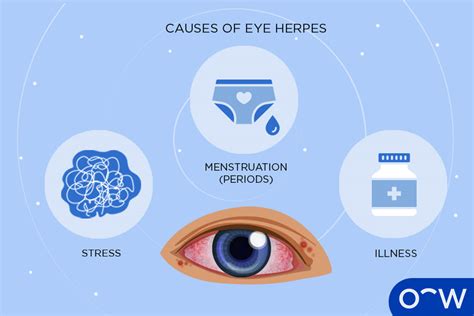 Eye Herpes Causes Symptoms Risk Factor And Treatment