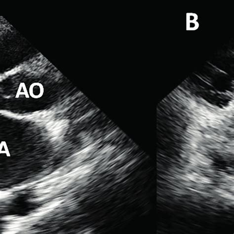 Transthoracic Echocardiography From Patient With Severe Mitral Stenosis Download Scientific