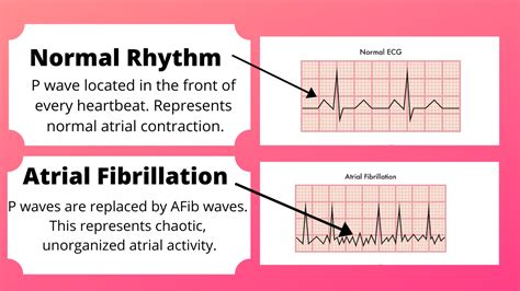 rapid or irregular heartbeats including atrial fibrillation pictures