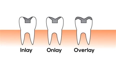 Dental Inlays And Onlays Restoration Owings Mills Md Dentist