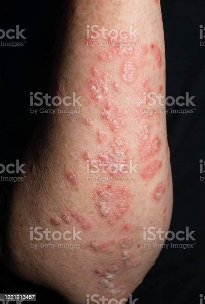 Inflamed Psoriatic Plaques On The White Skin Of The Womans Forearm On A