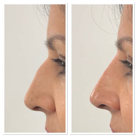 Finding The Best Nose Job Clinic Tips And Recommendations In Beverly