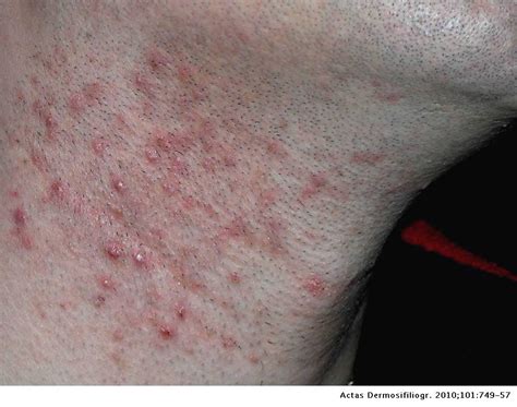 Pseudofoliculitis De La Barba Actas Dermo Sifiliográficas