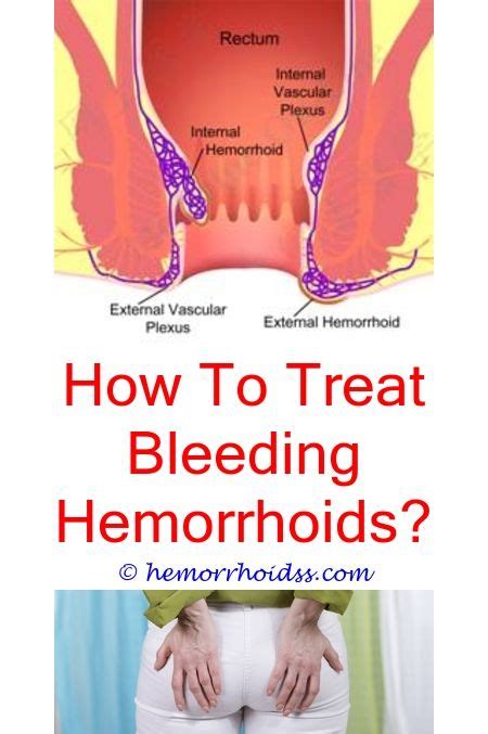 6 Positive Simple Ideas What Do Hemorrhoids Look Like Nhs Why Do
