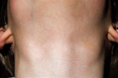 Swollen Lymph Glands In Neck Photograph By Dr P Marazzi Science Photo Library