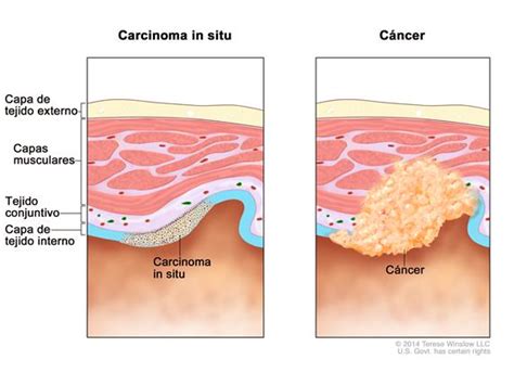 ♦ cáncer de ovario ovarian cancer. Definición de enfermedad en estadio 0 - Diccionario de ...