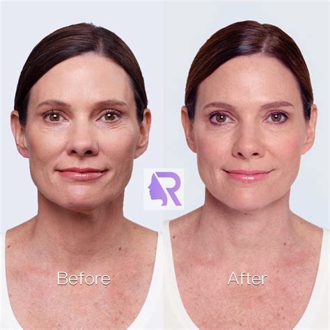 Instructions Before and After injection with facial fillers - Reverza