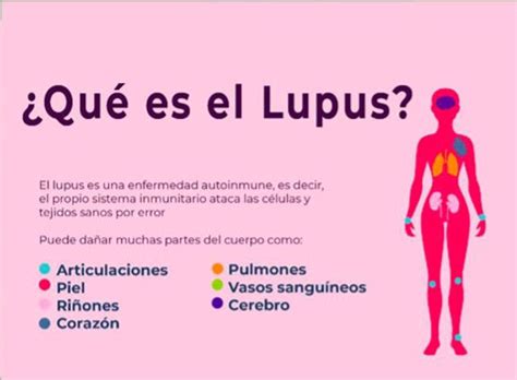 InformaciÓn General Del Lupus Eritematoso SistÉmico