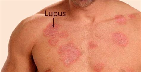 Lupus Rash On Body