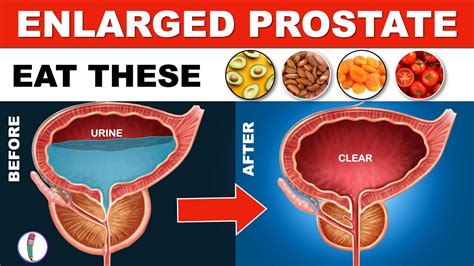 Prostate Enlargement Treatment Naturally Benign Prostatic Hyperplasia Enlarged Prostate