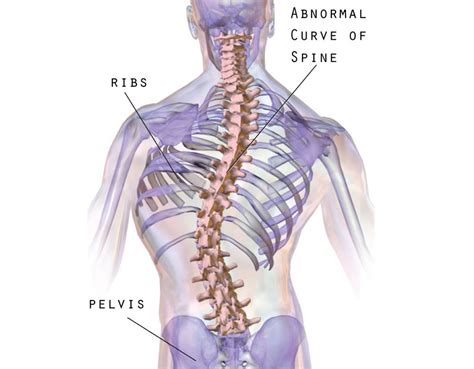 Scoliosis Advice And Reassurance Scoliosis Sos