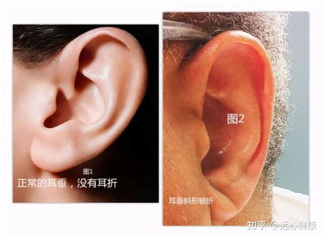耳朵上有这条折痕，是心脏不好的“标志”？听听专家怎么说 知乎
