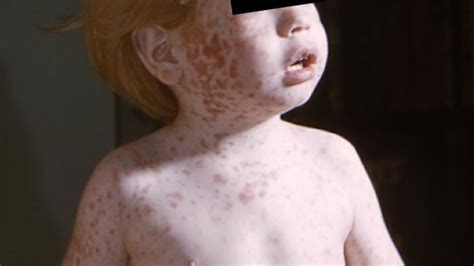 Us Measles Cases In 2013 May Be Most In 17 Years Cnn