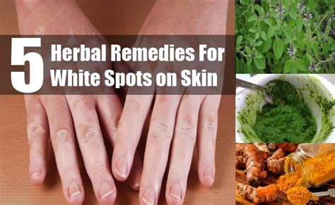 5 Herbal Remedies For White Spots On Skin Natural