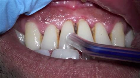 Severe Gum Disease Advance Periodontitis With Smoking Stain And Pus