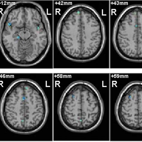 Integration Results Of Different Brain Areas In Bipolar Disorder