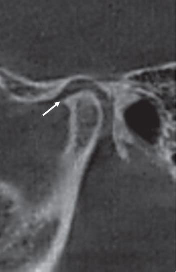 Osseous Changes In The Temporomandibular Joint In Rheumatoid Arthritis