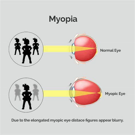 Effective Myopia Control In Boynton Beach Florida Eye And Ear Of The