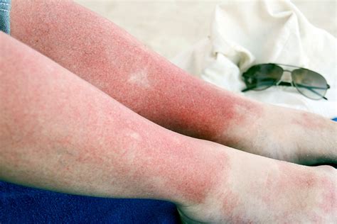 Too Much Sun What You Should Know About Sun Poisoning