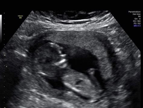 Nub Theory 12 Week Scan Mumsnet