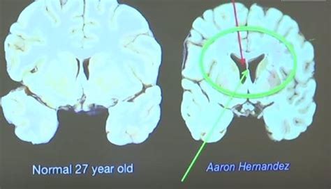 Analizan El Cerebro De Un Asesino Y El Resultado Es Sorprendente