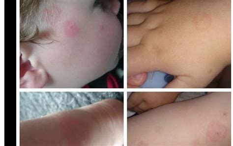 She Saw A Rash With A Strange Shape On Sons Temple And Issued This