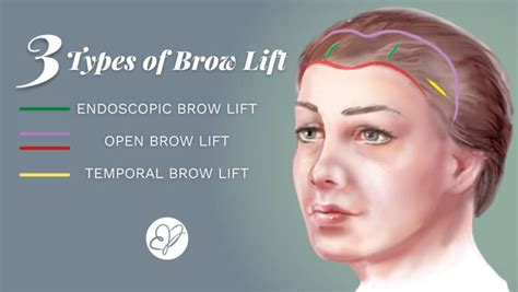 Types Of Brow Lifts Edina Plastic Surgery