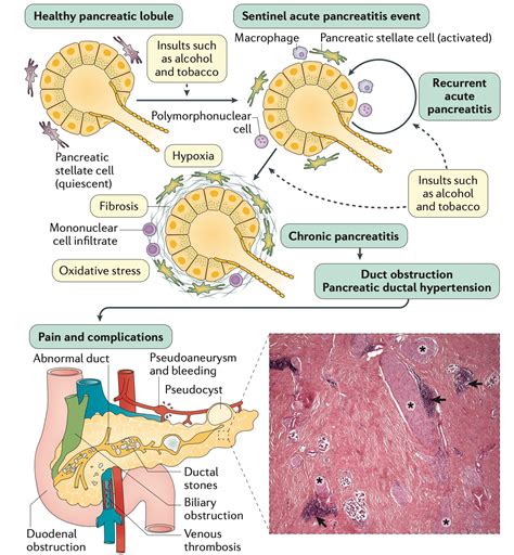 Keith Siau On Twitter Pathogenesis Of Chronic Pancreatitis 4KMedEd