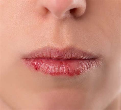 What Does Lip Cancer Look And Feel Like Sitelip Org