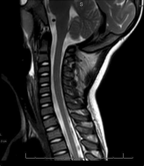Mri Of The Cervical Spine Interpretation The Brain Appears Normal