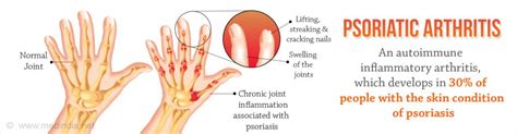 Psoriatic Arthritis Fusion Chiropractic