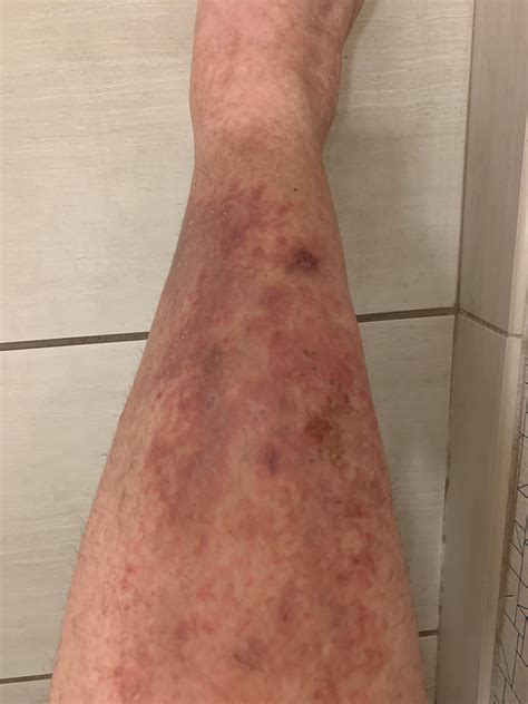 Lower Leg Rash Description In Comments Dermatology